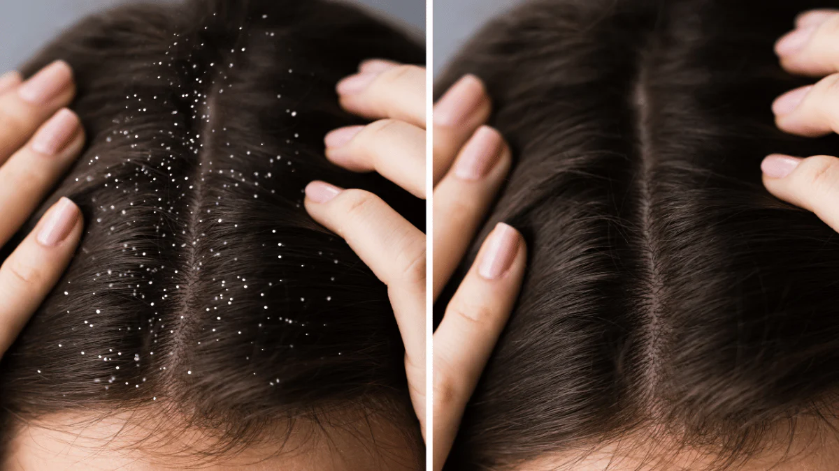 1. Dandruff and Scalp Irritation